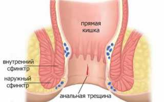 Лечение анальной трещины