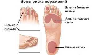 Как лечить диабетическую стопу в домашних условиях