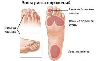 Как лечить диабетическую стопу в домашних условиях