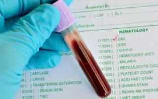 Латентная (скрытая) форма сахарного диабета