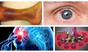 Сахарный диабет 2 типа