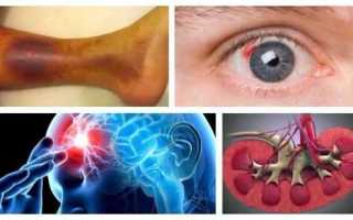 Сахарный диабет 2 типа