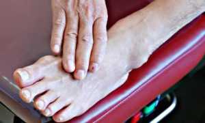 Как изменяются ногти при сахарном диабете?