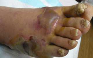 Гангрена нижних конечностей при сахарном диабете