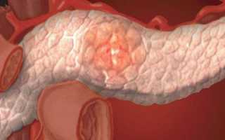 Что такое жидкость в полости поджелудочной железы, причины и лечение патологии