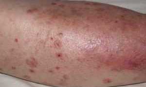 Диабетическая дермопатия