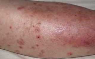 Диабетическая дермопатия