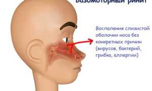 Как лечить вазомоторный ринит у детей