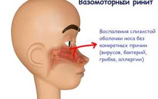 Как лечить вазомоторный ринит у детей