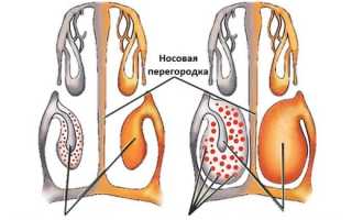 Вазомоторный ринит беременных