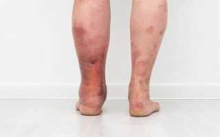 Диабетическая ангиопатия. Ангиопатия сосудов нижних конечностей