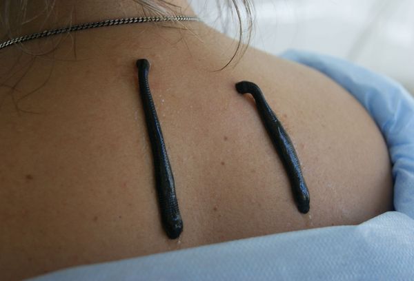 Пиявки на спине