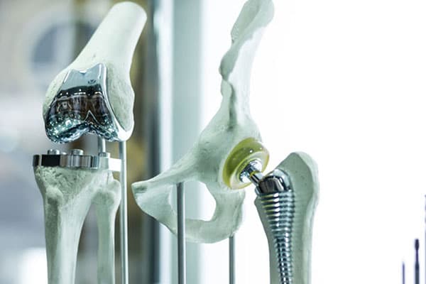 Металлические протезы суставов