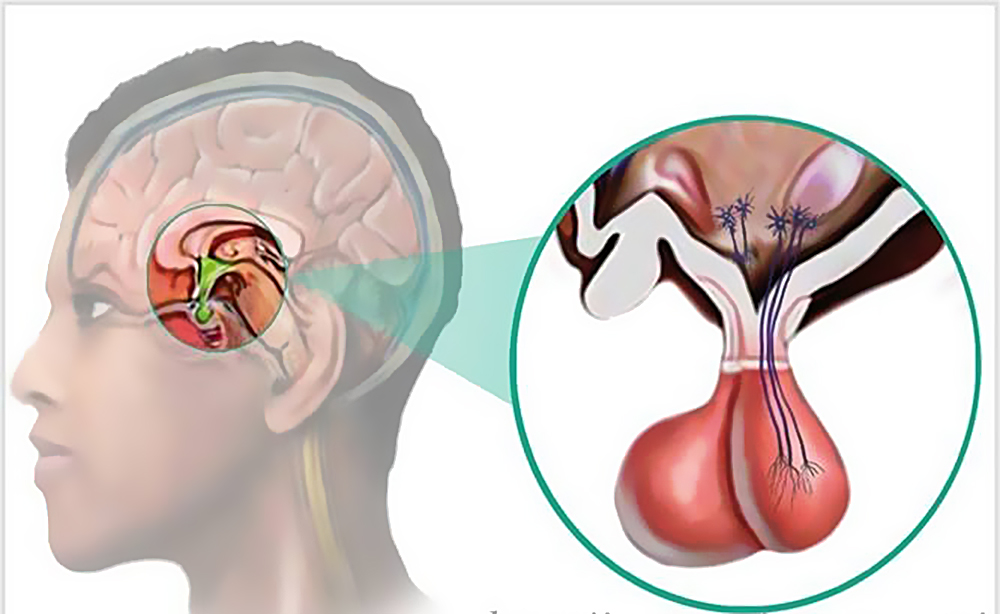 Что такое аденома гипофиза?