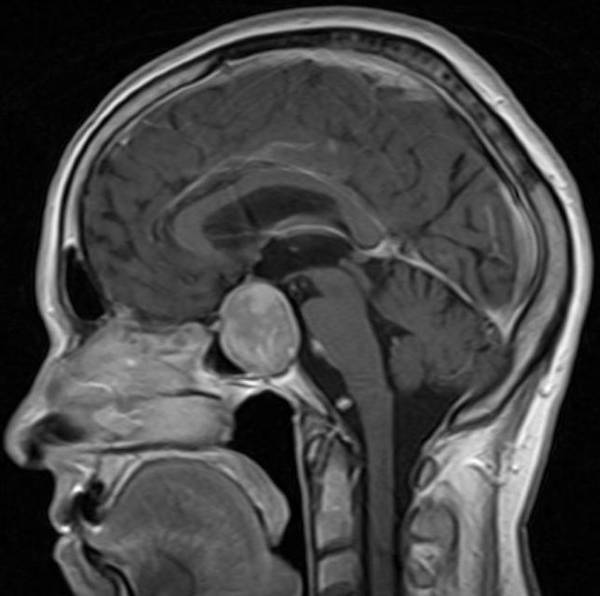 Аденома гипофиза на снимке