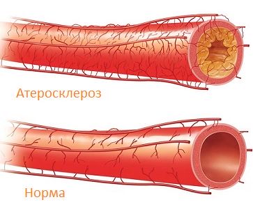 Атеросклероз