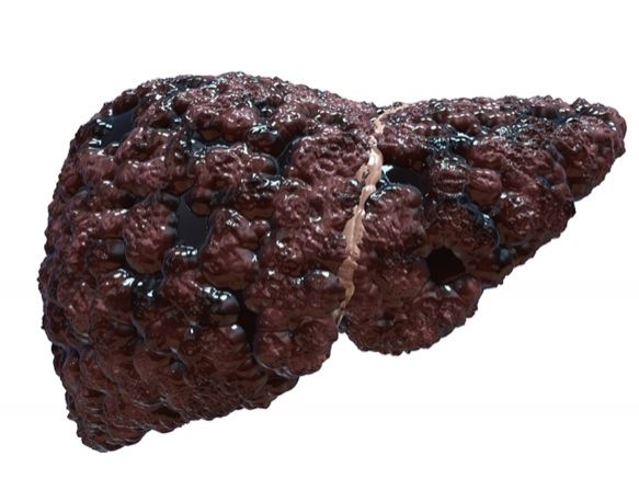 Цирроз печени