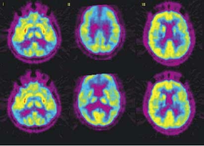 Снимок энцефалопатии в мозге