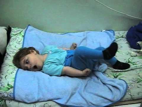 Судороги при эпилепсии