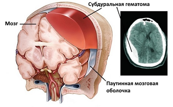 Субдуральная гематома