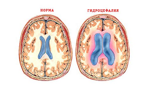 Мозг с гидроцефалией