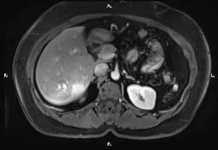 Глиозные изменения на снимке