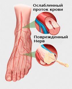 Полинейропатия при диабете