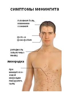 Симптомы менингита