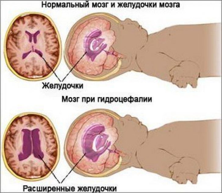 Мозг при гидроцефалии