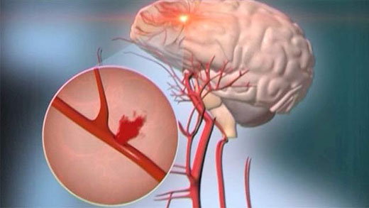 Как выглядит кровоизлияние в мозг?