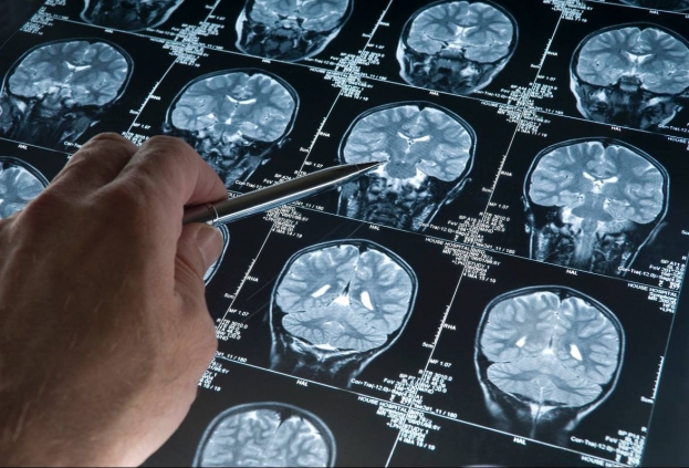 Результаты МРТ