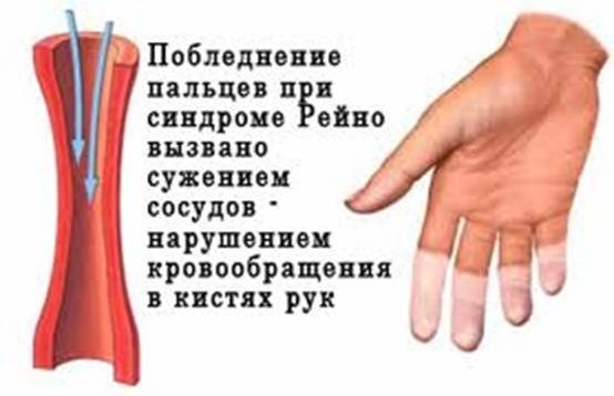 Симптомы синдрома Рейно