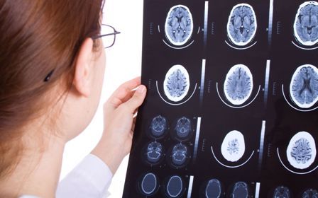 Снимки кисты мозга