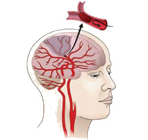 Хроническая ишемия головного мозга