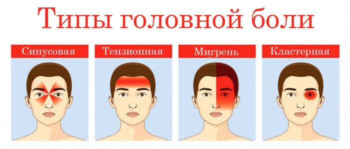 Виды головной боли