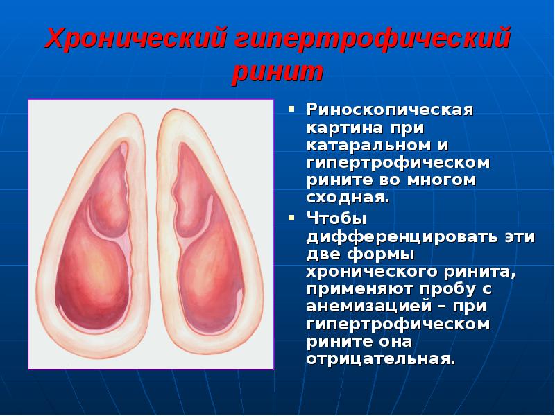 Хронический гипертрофический ринит