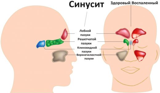 локализация синусита