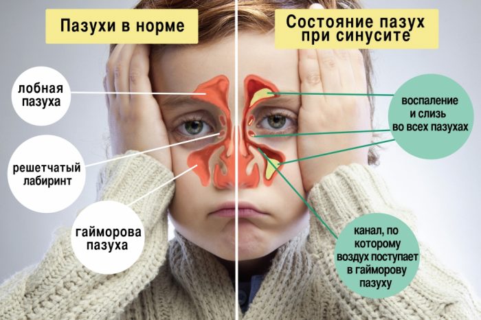 Антибиотики при насморке