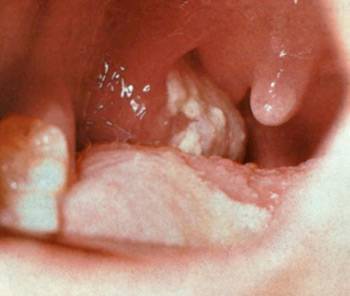 Ангина-Симановского-Венсана