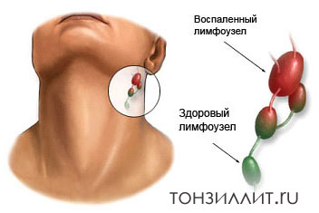 Увеличенные лимфатические узлы