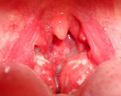 Фолликулярная форма ангины