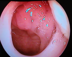 Аденоиды 1-2 степени у взрослых под эндоскопом