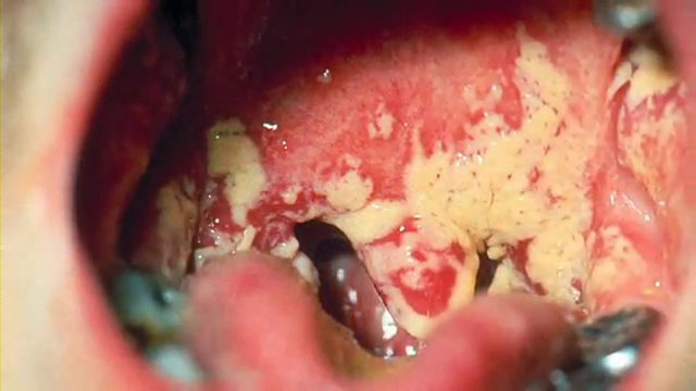 Грибковое поражение полости рта