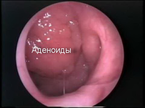 На фото показано, как выглядят аденоиды в носу под эндоскопом