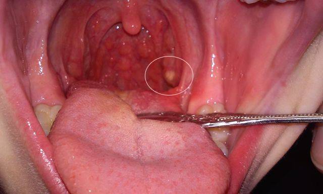 Киста-на-миндалине