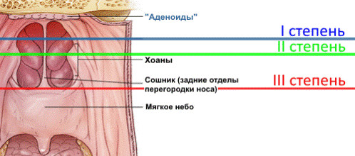 Классификация аденоидов фото 2