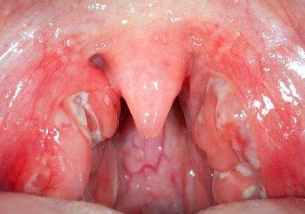 Лакунарная-ангина