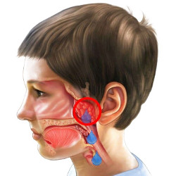 adenoidit