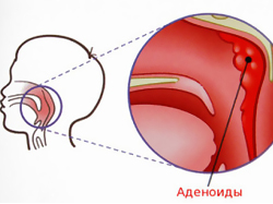 аденоиды