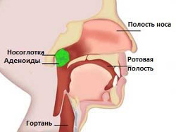 аденоиды